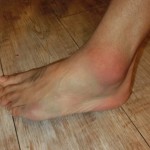 ひねって腫れた足